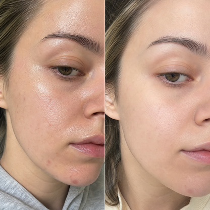 Set pentru acnee: gel, seruri PURE AM și PM, stick și ceai ACNE GONE