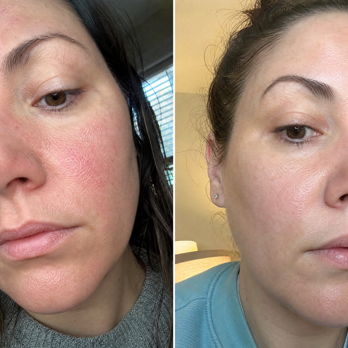 Ser facial CALM - pentru rozacee