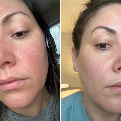 Ser facial CALM - pentru rozacee